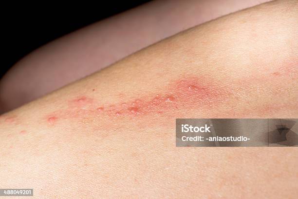 イル皮膚疾患 Eczema - アトピー性皮膚炎のストックフォトや画像を多数ご用意 - アトピー性皮膚炎, アレルギー, クローズアップ