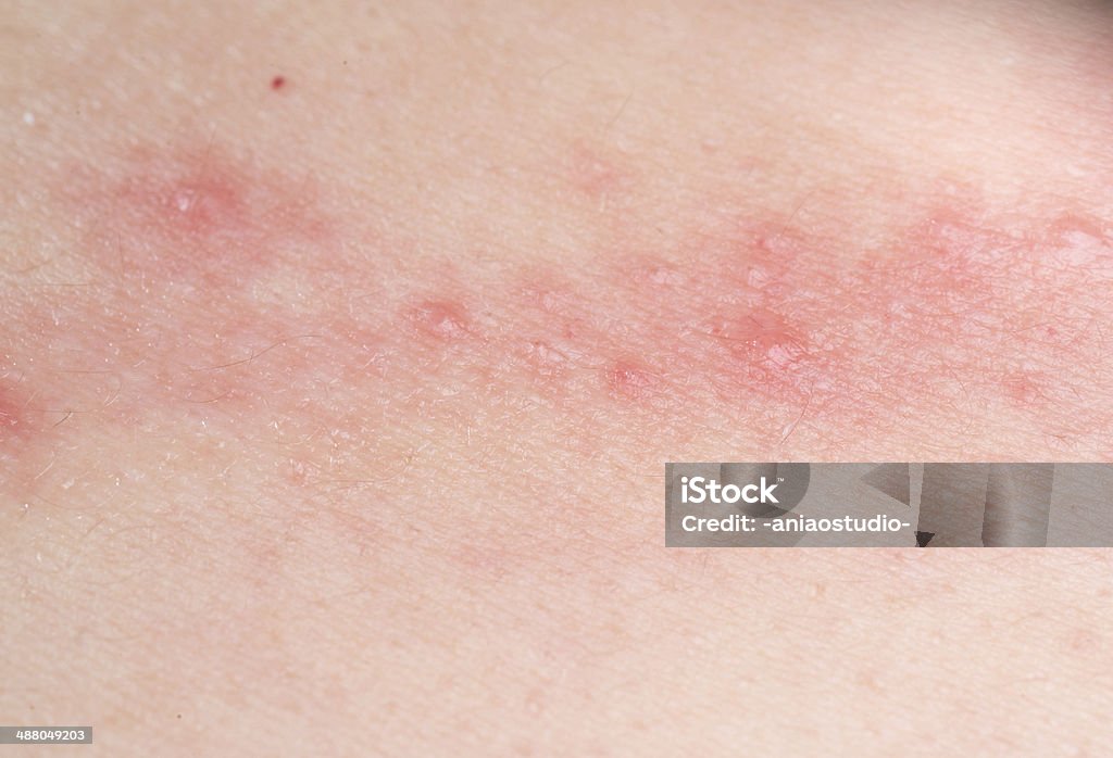 III 피부 질환 습진 - 로열티 프리 습진 스톡 사진