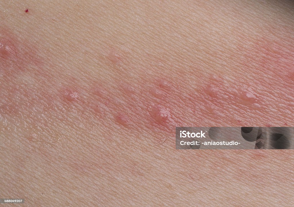 ill Haut Krankheit eczema - Lizenzfrei Toxikodermatitis Stock-Foto