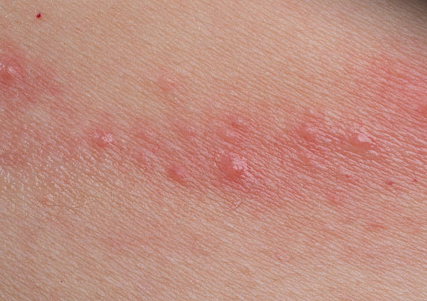 ill haut krankheit eczema - toxicodermatitis stock-fotos und bilder