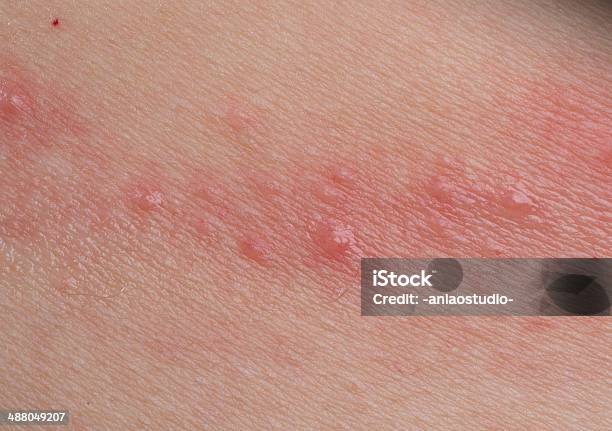 Ill Haut Krankheit Eczema Stockfoto und mehr Bilder von Toxikodermatitis - Toxikodermatitis, Kratzen, Struktureffekt