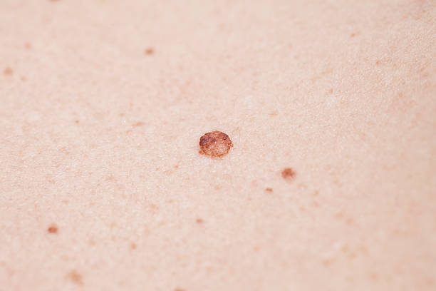 Cтоковое фото Рак кожи