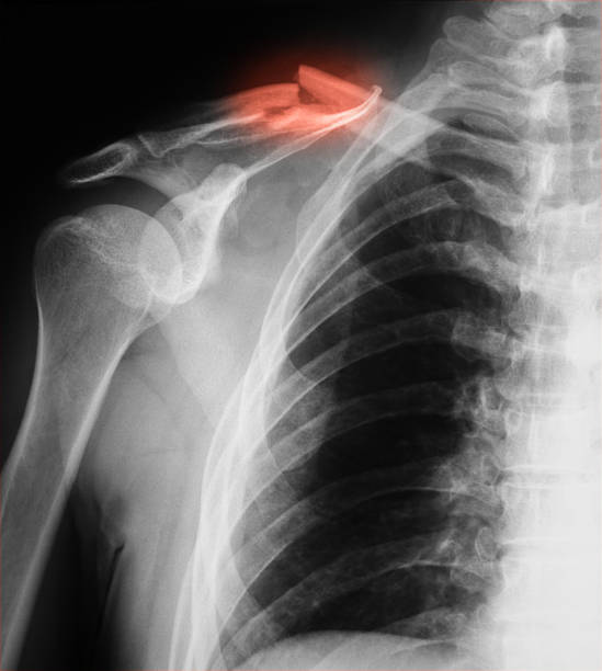 image au rayon x de la clavicule fissure, ap. - x ray x ray image shoulder human arm photos et images de collection