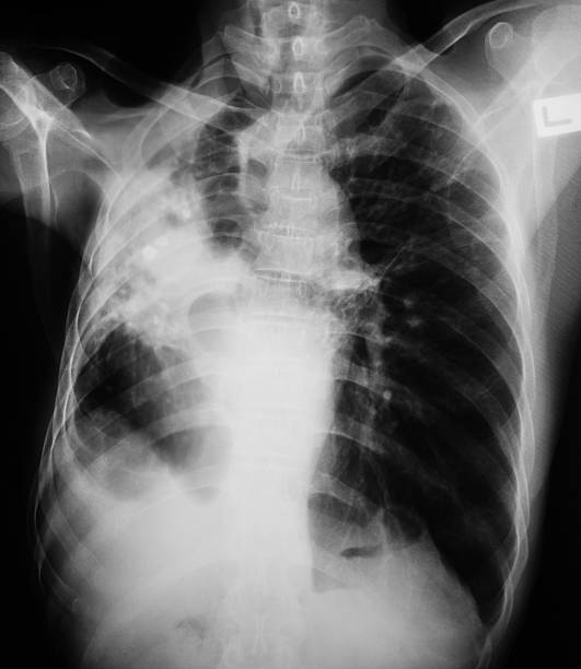 istock Chest x-ray image showing lung infection. 488094010