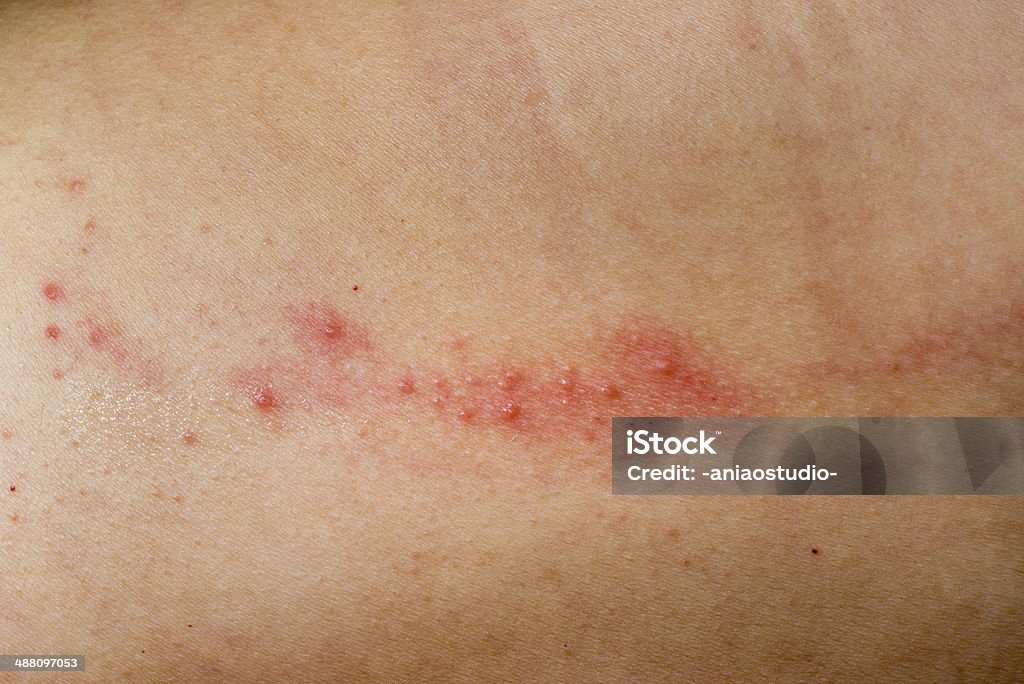Mal doença cutânea eczema - Royalty-free Alergia Foto de stock