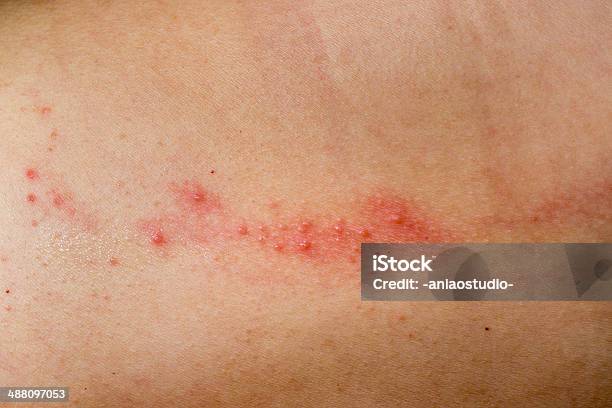 Mal Doença Cutânea Eczema - Fotografias de stock e mais imagens de Alergia - Alergia, Dermatite Tóxica, Condição