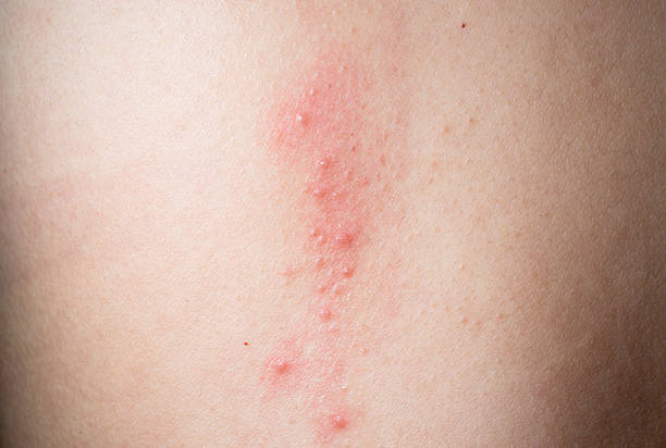 ill haut krankheit eczema - toxicodermatitis stock-fotos und bilder