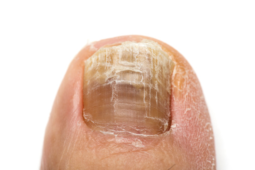 Uña del dedo del pie photo