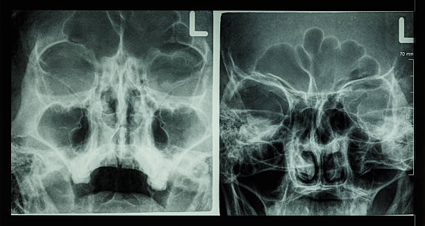 istock Film x-ray paranasal sinus 488439558