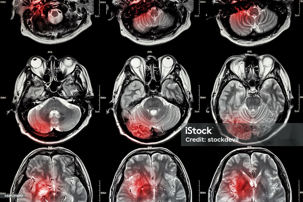 Film MRI (résonance magnétique de cerveau Images - Photo de Image par résonance magnétique libre de droits