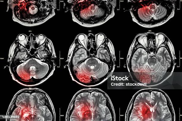 Photo libre de droit de Film Mri Résonance Magnétique De Cerveau Images banque d'images et plus d'images libres de droit de Image par résonance magnétique - Image par résonance magnétique, Attaque cérébrale, Cancer