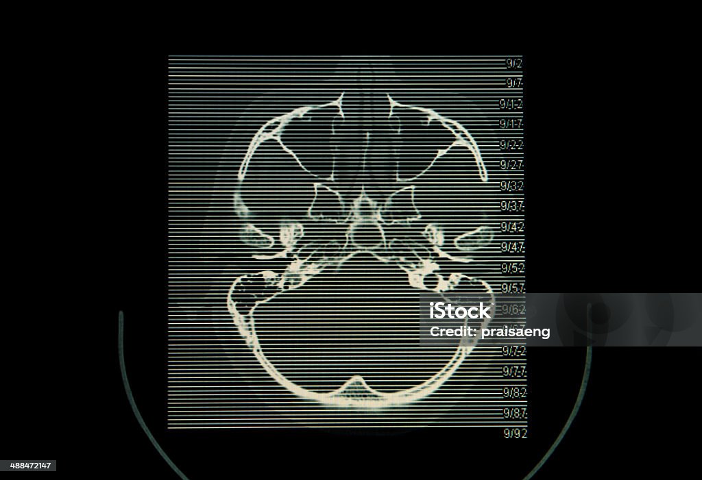 CT ( computed tomography imaging )scan image of brain. Alzheimer's Disease Stock Photo