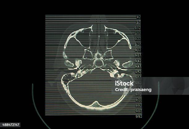 Ct Scan Image Of Brain Stock Photo - Download Image Now