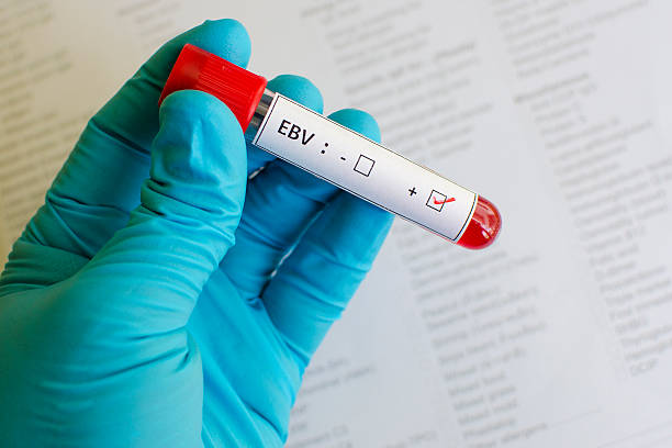 Epstein-Barr virus (EBV) positive Blood sample with epstein-barr virus (EBV) positive epstein barr virus photos stock pictures, royalty-free photos & images