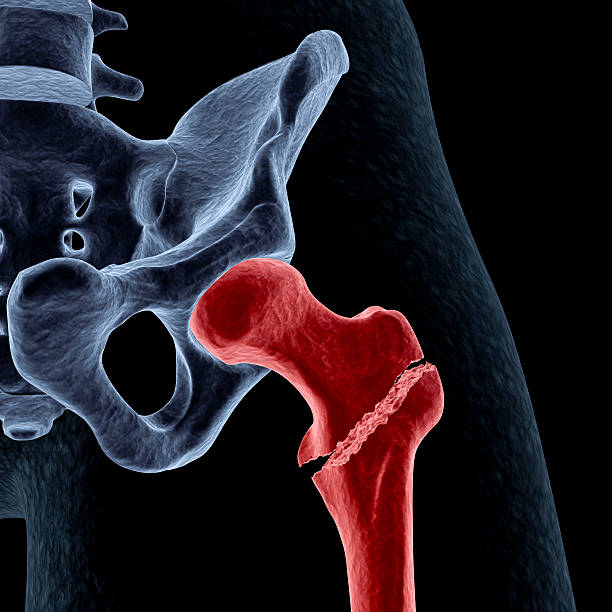 Intertrochanteric hip fracture stock photo