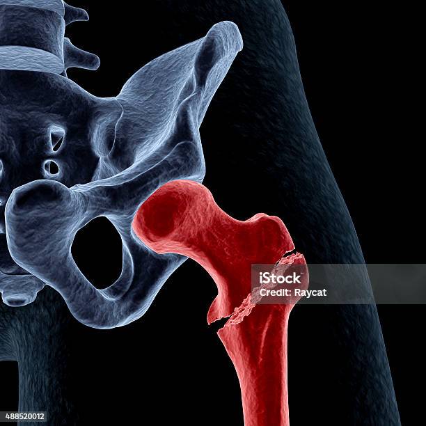 Intertrochanteric Hip Fracture Stock Photo - Download Image Now - Bone Fracture, Broken, Hip - Body Part