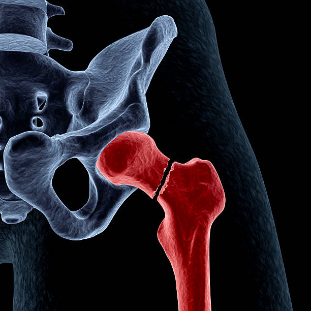 Intracapsular hip fracture stock photo