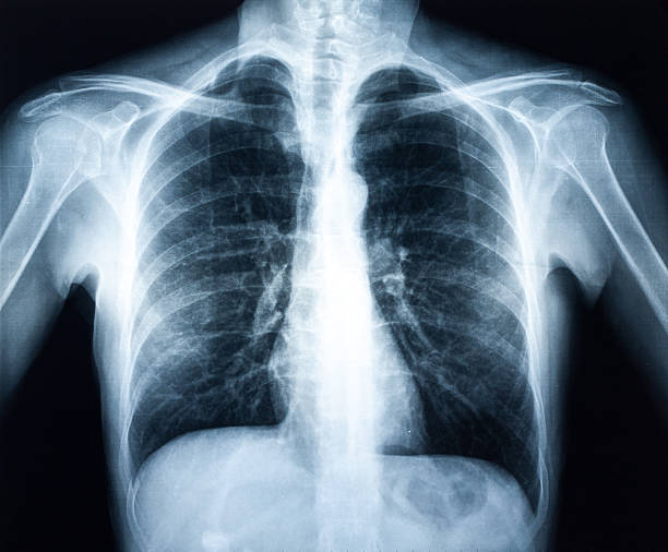 인간 torax x-선 - x ray 뉴스 사진 이미지