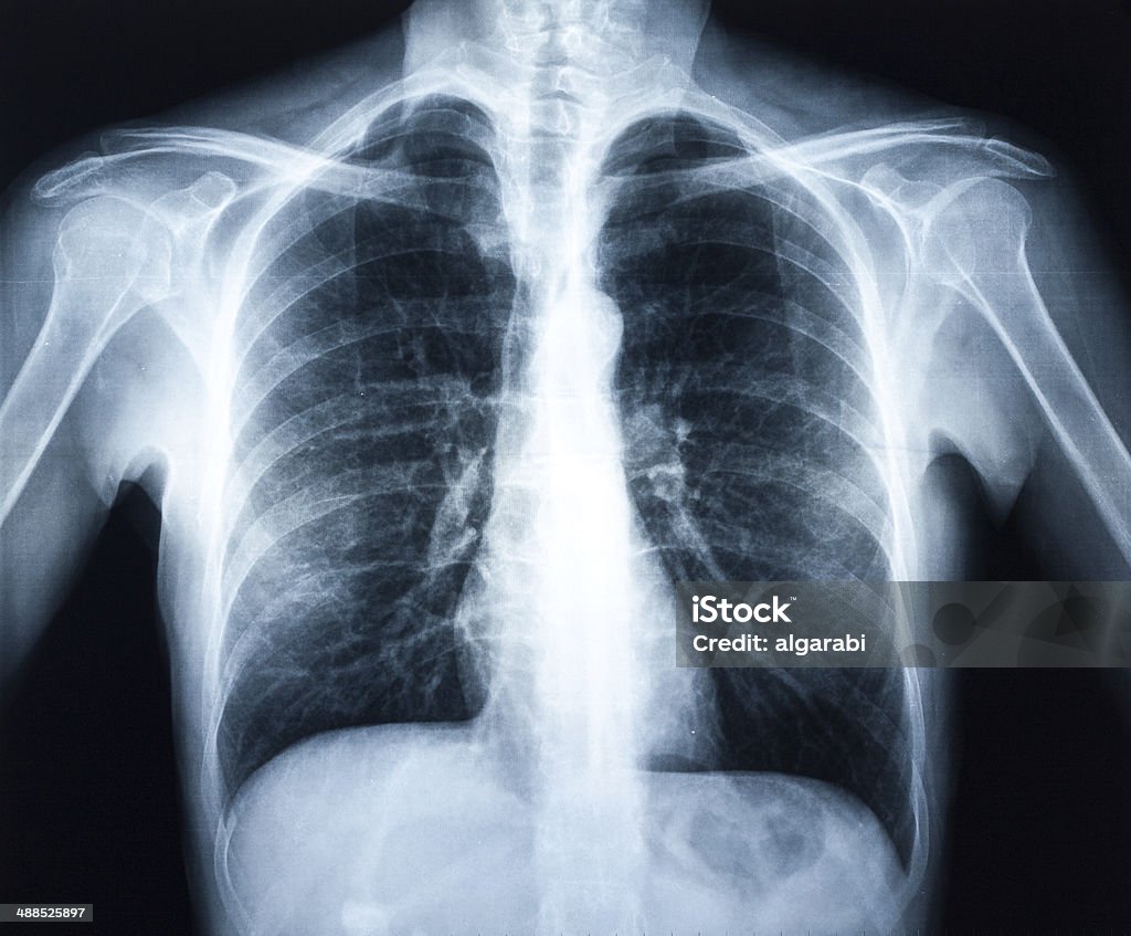 Xray of a human torax Xray of a human torax isolated X-ray Image Stock Photo