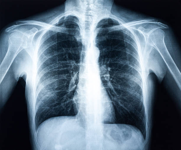 rtg ludzkie torax - x ray chest human lung rib cage zdjęcia i obrazy z banku zdjęć