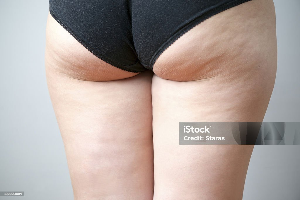 Fatty female hips Fatty female hips. Skin care, cellulite. Obesity Cellulite Stock Photo