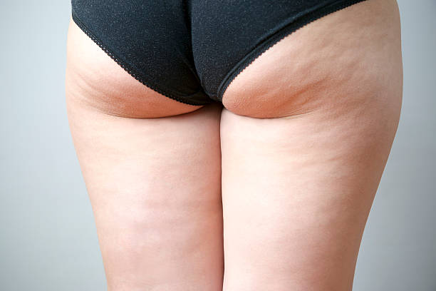 Fatty female hips Fatty female hips. Skin care, cellulite. Obesity cellulite stock pictures, royalty-free photos & images