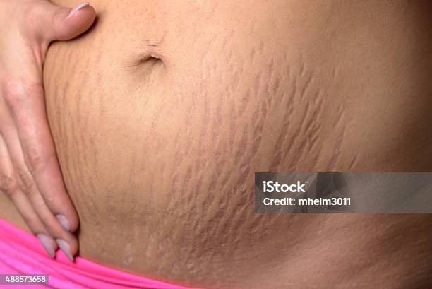 Estiramiento Mujer Mostrando Marca Después De Embarazo Foto de stock y más banco de imágenes de Embarazada