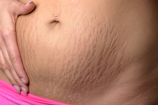 kobieta wyświetlono stretch marks po ciąży - human pregnancy abdomen naked human hand zdjęcia i obrazy z banku zdjęć