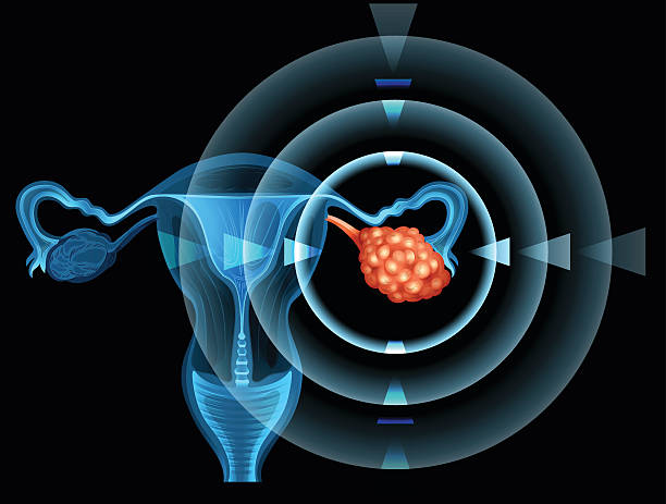 Cancer in ovary of woman Cancer in ovary of woman illustration ovarian cancer stock illustrations
