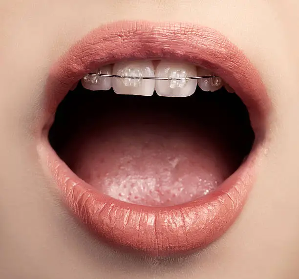 Photo of braces on teeths