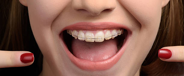 посмотрите на мои брекеты - human teeth smiling dental hygiene women стоковые фото и изображения