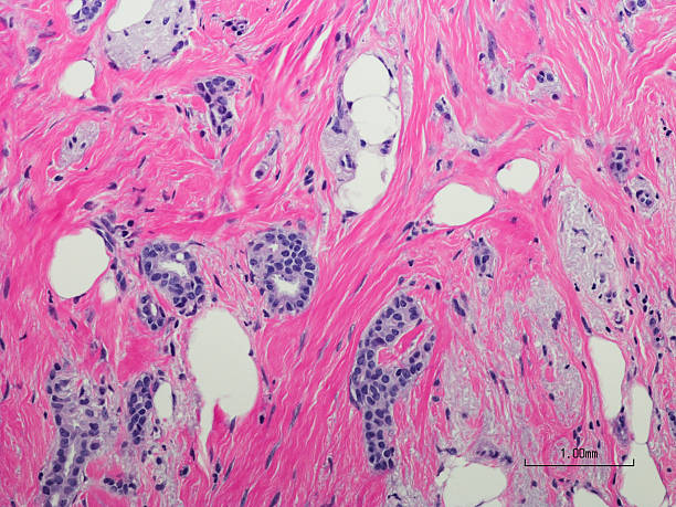 Invasive ductal carcinoma (breast cancer) low grade. Microscopic photo of a professionally prepared slide demonstrating breast tissue with ductal carcinoma.  Invasive ductal carcinoma (breast cancer) low grade. Ductal means that the cancer starts inside the milk ducts, carcinoma refers to any cancer that begins in the skin or other tissues (including breast tissue) that cover or line the internal organs light micrograph stock pictures, royalty-free photos & images