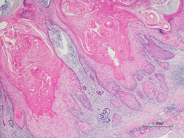 keratinizing плоскоклеточный рак кожи - scientific micrograph стоковые фото и изображения