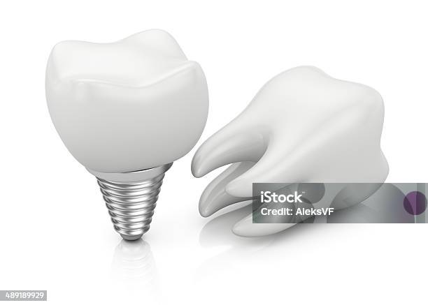 Dente E Impianto Dentale - Fotografie stock e altre immagini di Accudire - Accudire, Apparecchiatura odontoiatrica, Bianco