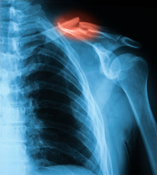 image au rayon x de la clavicule, ap. - x ray x ray image shoulder human arm photos et images de collection