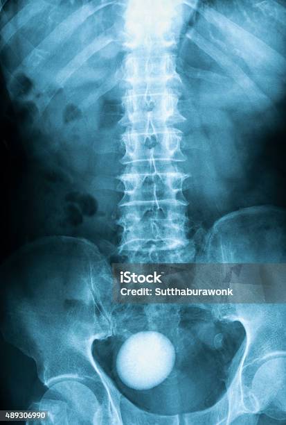 Xray Image Of Plan Kub Supine View Stock Photo - Download Image Now - 2015, Anatomy, Black And White