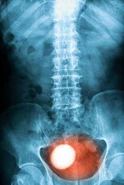 x-ray изображение план kub, лежа на. - healthcare and medicine human heart abdomen human spine стоковые фото и изображения