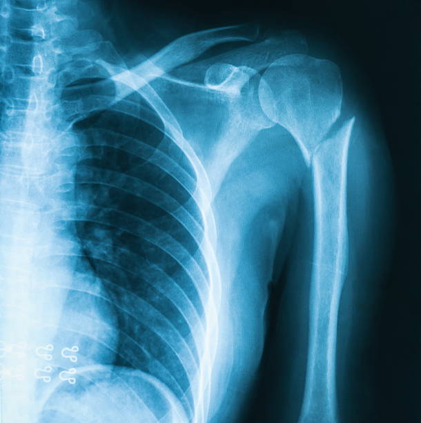 humérus fissure x-ray image. - humerus photos et images de collection