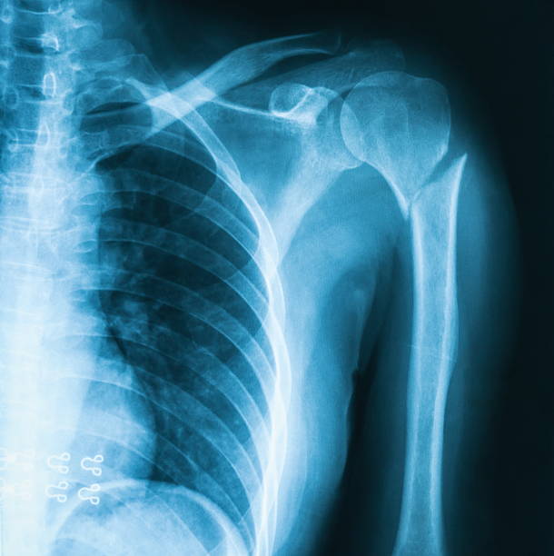 상완골 골절 x-선 영상을. - human lung x ray image x ray human spine ��뉴스 사진 이미지