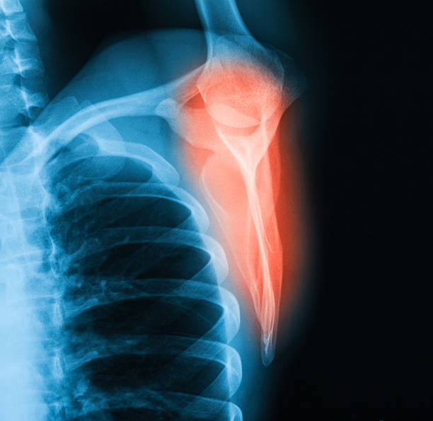 image au rayon x d'épaule, transcapular sur la ville. - x ray x ray image shoulder human arm photos et images de collection