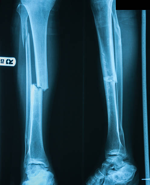 X-ray image of leg fracture with wooden splint. X-ray image of leg fracture ,AP and lateral view. After removed internal fixator (compression plate and screws. tibia photos stock pictures, royalty-free photos & images