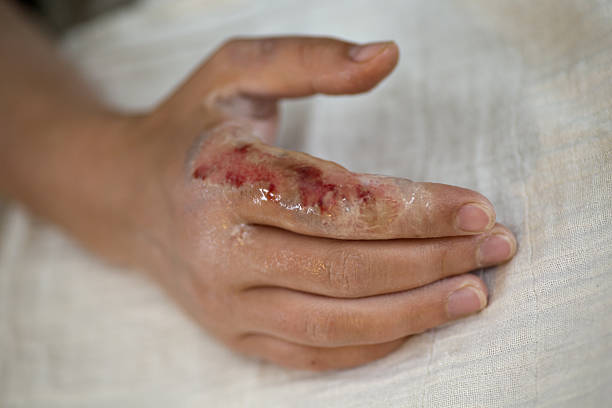 Hand with a third degree burn after fire damage stock photo