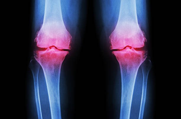 Osteoarthritis Knee ( OA Knee ) Osteoarthritis Knee ( OA Knee ). Film x-ray both knee ( front view ) show narrow joint space ( joint cartilage loss ) , osteophyte , subchondral sclerosis tibia photos stock pictures, royalty-free photos & images