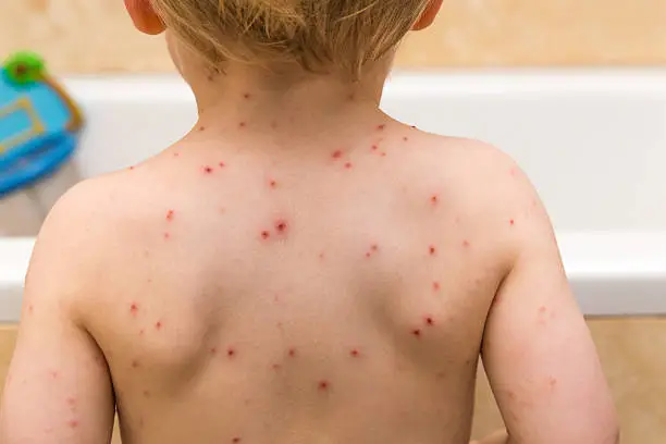 Two year old boy with Chicken Pox