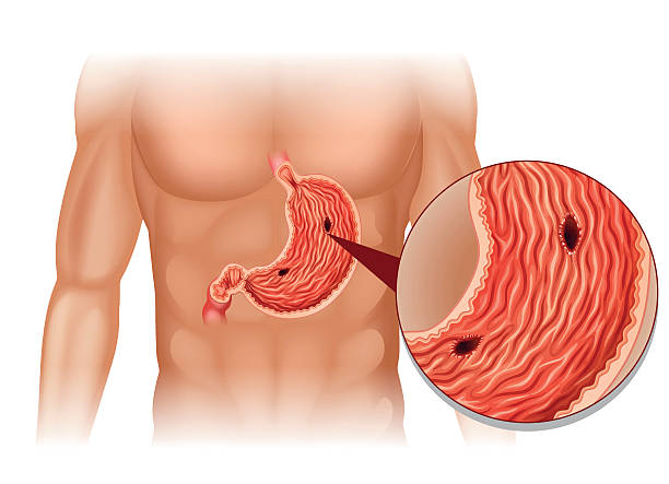 Stomach Ulcer Human Body Stock Illustration - Download Image Now - Gastric Ulcer, 2015, Anatomy - iStock