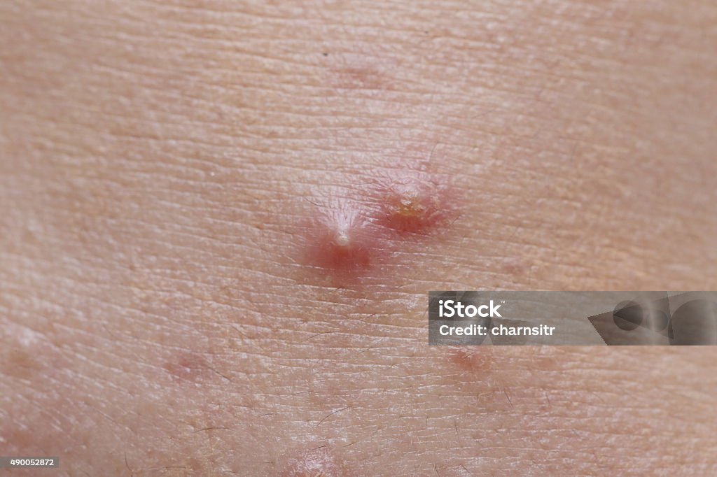 pimple on woman skin close-up pimple on woman skin 2015 Stock Photo