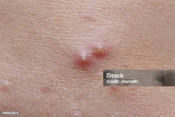 Pimple On Woman Skin Stock Photo - Download Image Now - 2015, Adult, Blackhead