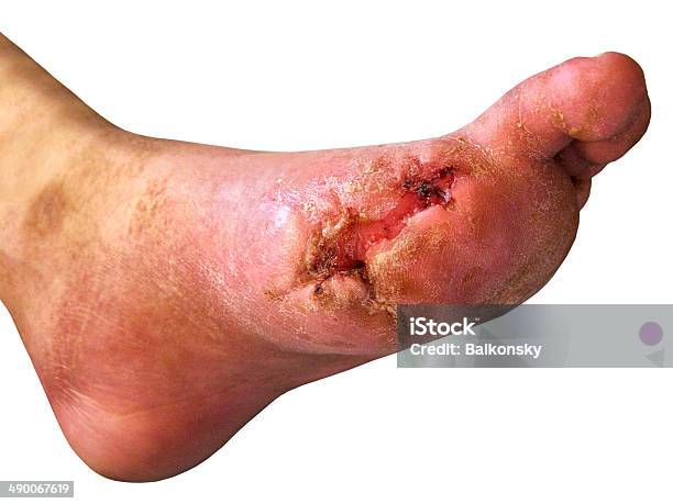 Diabetic Foot Stock Photo - Download Image Now - Amputee, Illness, Ulcer