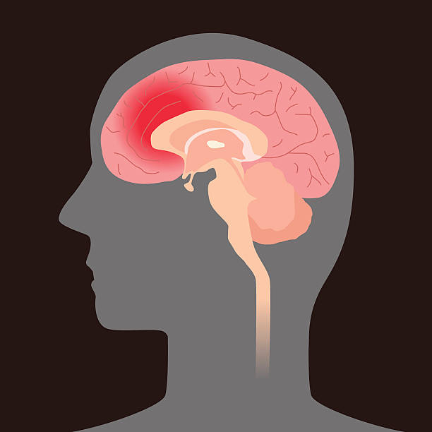 ilustrações, clipart, desenhos animados e ícones de hemorragia cerebral, ilustração de imagem - brain human spine brain stem cerebellum