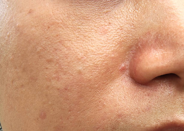 istock Woman with oily skin and acne scars 490184828